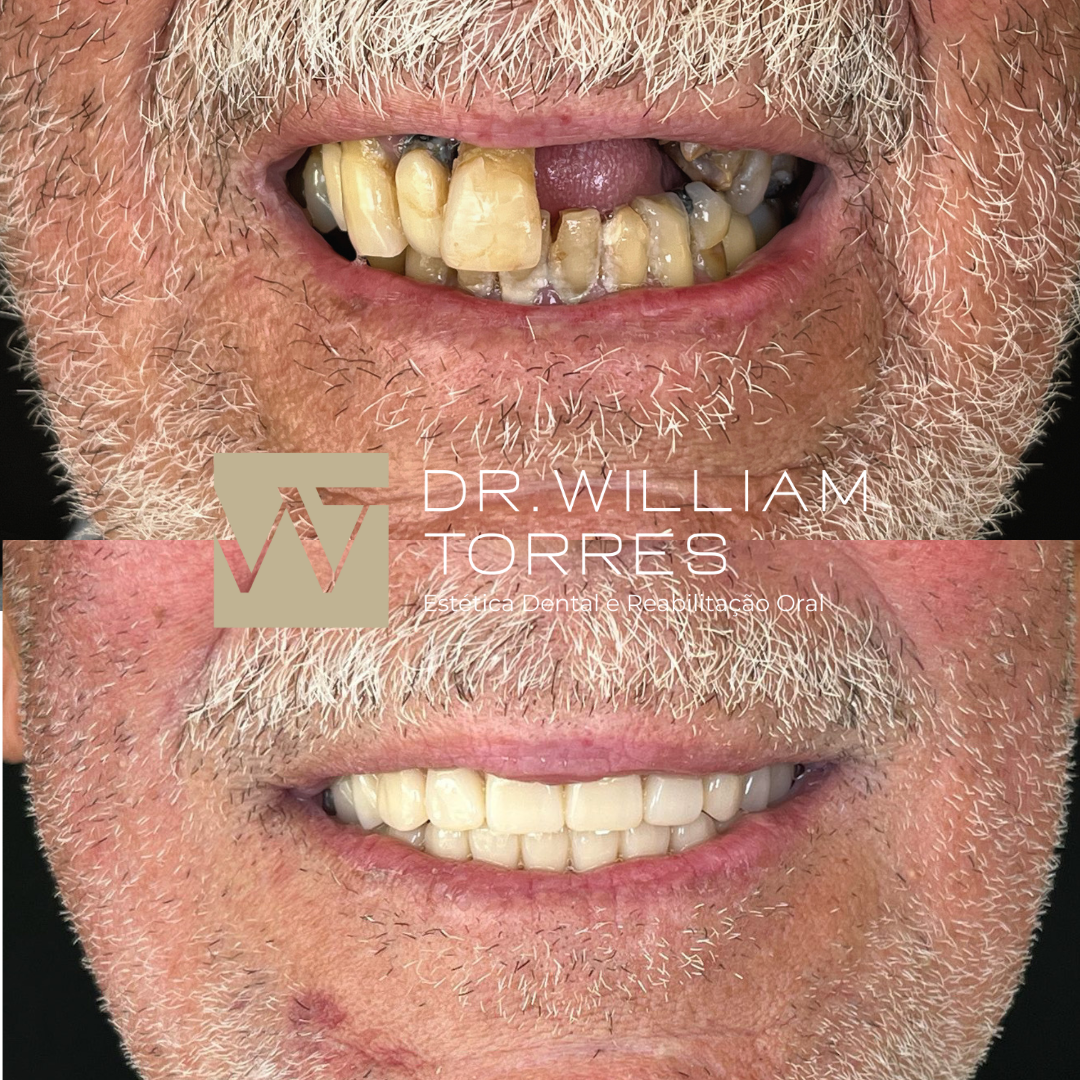 Galego antes e depois