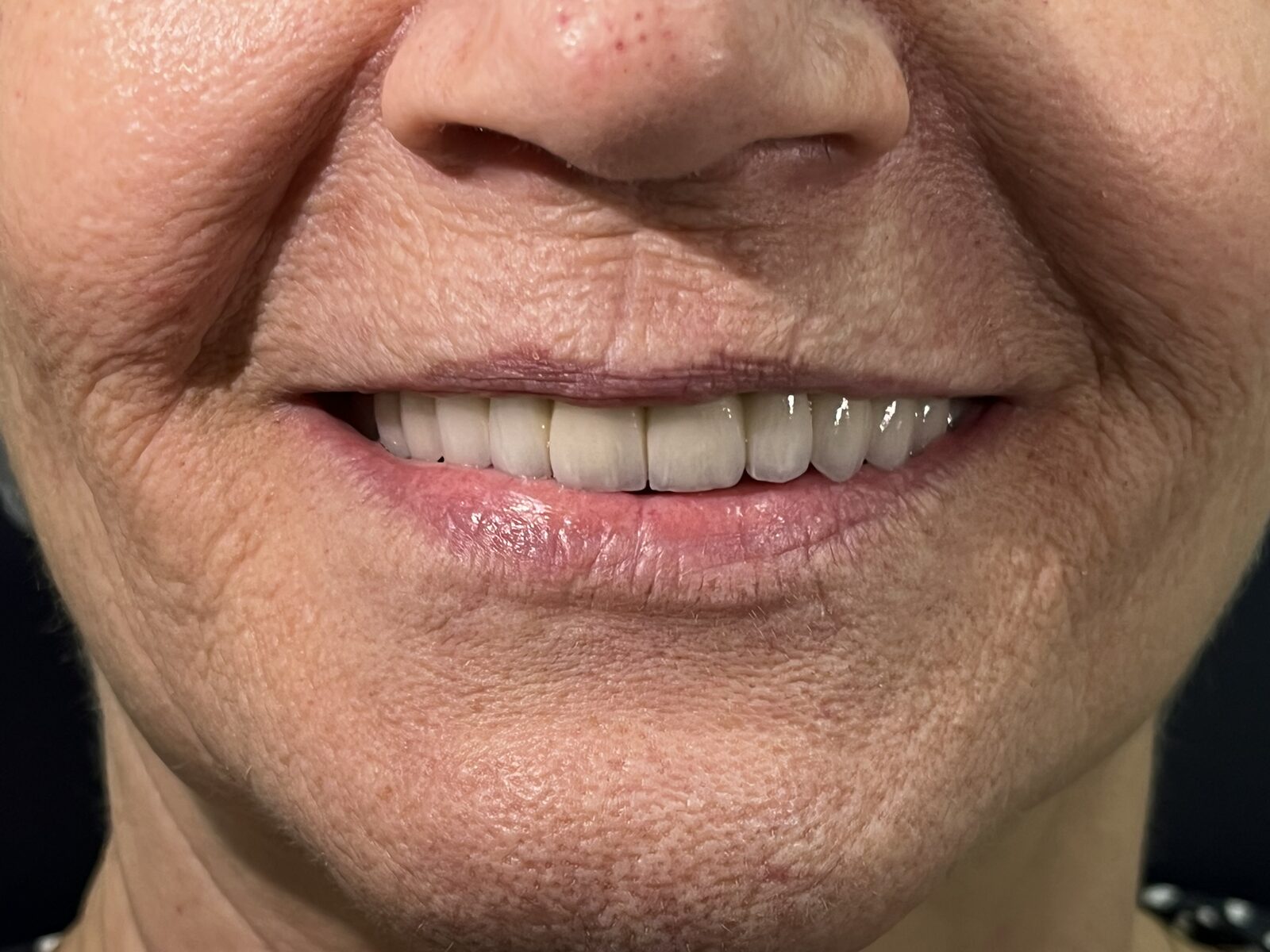 Próteses Dentárias